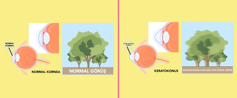 Keratokonus Nedir?